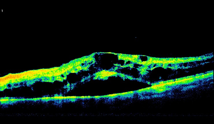Ocular Imaging - Corresponding OCT of CRV thrombosis showing cystoids oedema and sub retinal fluid.