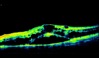 Ocular Imaging - Corresponding OCT of CRV thrombosis showing cystoids oedema and sub retinal fluid.