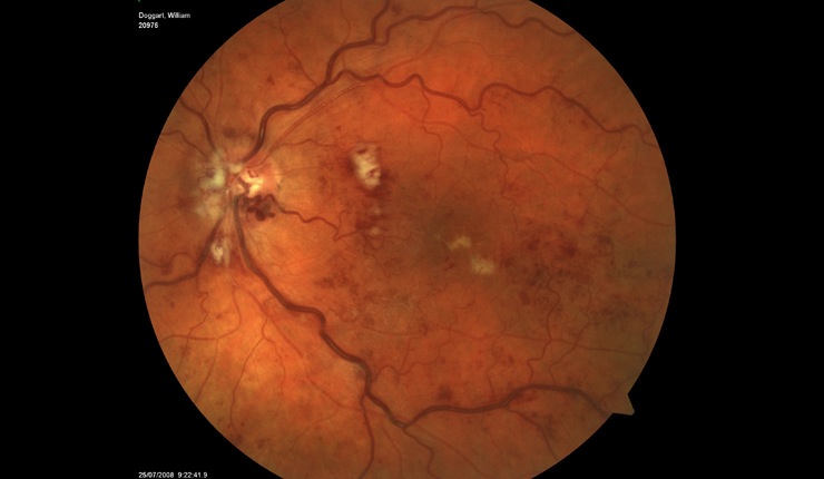 Ocular Imaging - CRV thrombosis following triamcinilone treatment.