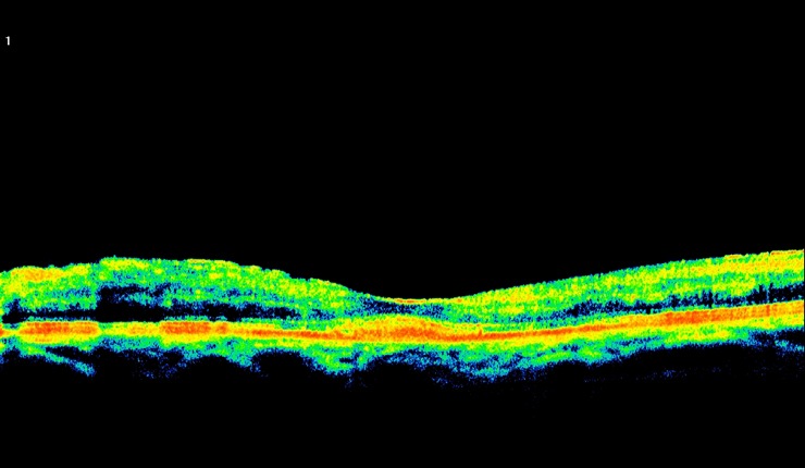 Ocular Imaging - OCT showing resolution of fluid following triamcinilone treatment.