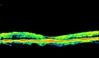 Ocular Imaging - OCT showing resolution of fluid following triamcinilone treatment.