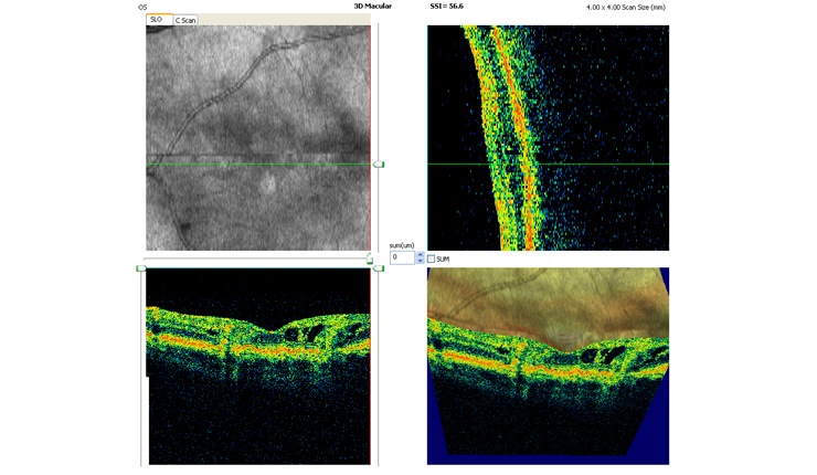 Ocular Imaging - 3D OCT of retinal angiomatous proliferation (RAP) showing news vessels tracking through the retina and associated intra-retinal oedema.