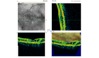 Ocular Imaging - 3D OCT of retinal angiomatous proliferation (RAP) showing news vessels tracking through the retina and associated intra-retinal oedema.