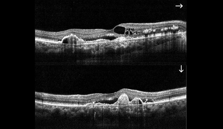 Ocular Imaging - AMD. High resolution horizontal and vertical scans showing cystoids oedema, CNV, RPE proliferation and sub retinal fluid at the fovea.