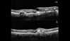 Ocular Imaging - AMD. High resolution horizontal and vertical scans showing cystoids oedema, CNV, RPE proliferation and sub retinal fluid at the fovea.