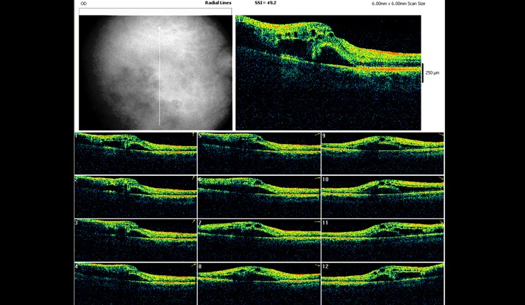 Ocular Imaging - OCT radial scan display showing arcade pattern of fluid associated with branch retinal vein occlusion.