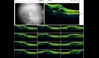 Ocular Imaging - OCT radial scan display showing arcade pattern of fluid associated with branch retinal vein occlusion.