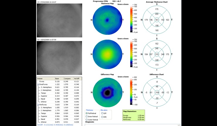 Ocular Imaging - Progression retinal thickness maps showing resolution of fluid following triamcinilone treatment.
