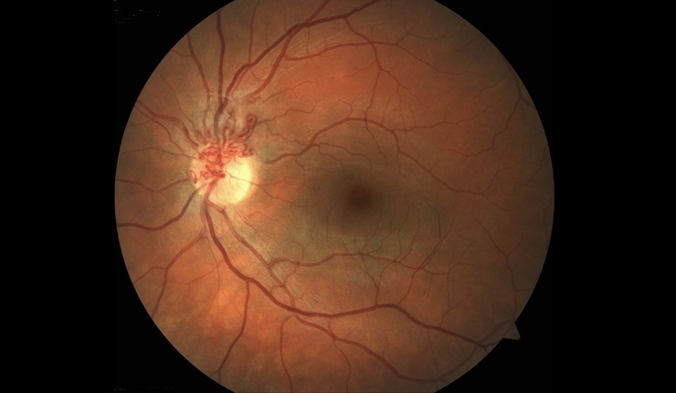 Ocular Imaging - Fundus photograph of tortuous optic nerve vessels.