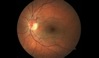 Ocular Imaging - Fundus photograph of tortuous optic nerve vessels.