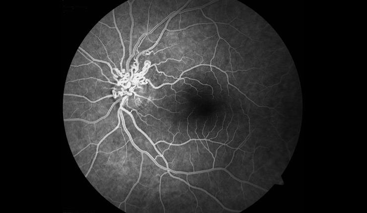 Ocular Imaging - Fluorescein angiogram of previous image highlighting the vessels but showing no evidence of leakage.