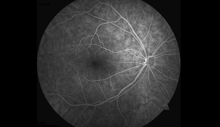 Ocular Imaging - Fluorescein angiogram of normal retina.