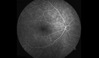 Ocular Imaging - Fluorescein angiogram of normal retina.