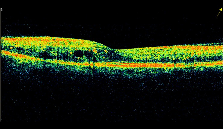 Ocular Imaging - Diabetic Retinopathy showing cystoids oedema, hard exudates and retinal thickening.