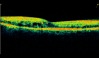 Ocular Imaging - Diabetic Retinopathy showing cystoids oedema, hard exudates and retinal thickening.