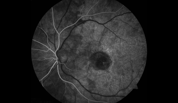 Ocular Imaging - AMD-Early phase fluorescein angiogram.