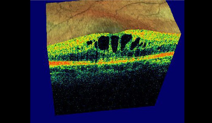 Ocular Imaging - 3D retinal scan showing sub foveal cystoid oedema.