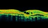 Ocular Imaging - Wet AMD associated cystoids oedema with shallow pigment epithelial detachment.