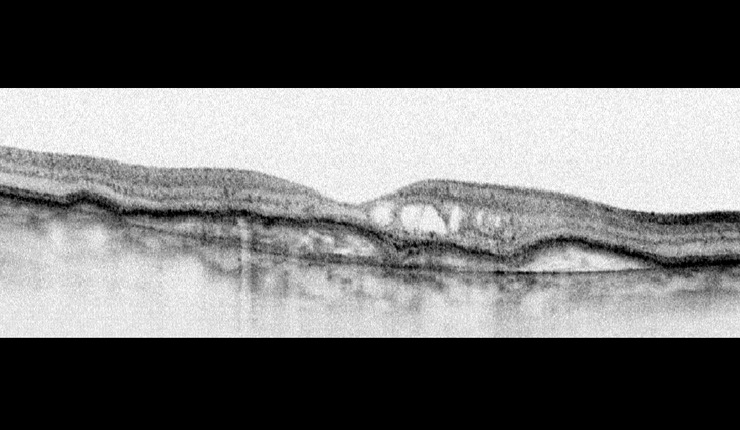 Ocular Imaging - Greyscale picture of previous scan showing Bruch’s membrane.