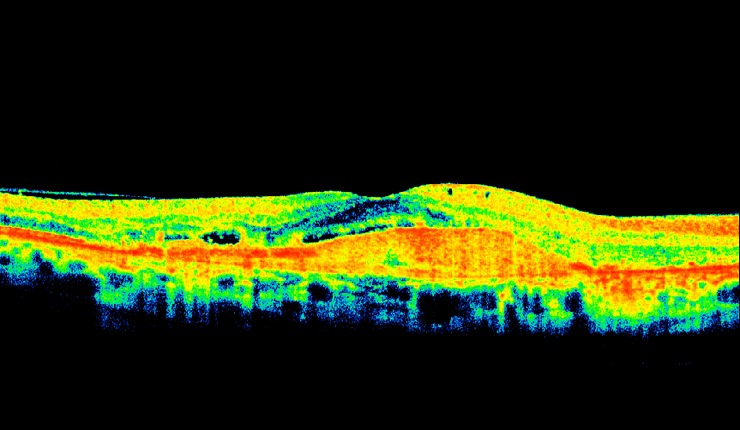 Ocular Imaging - Highly reflective choroidal neovascular membrane (CNV) associated with AMD. Some residual fluid remaining at the interface of the CNV and outer retina.