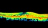 Ocular Imaging - Highly reflective choroidal neovascular membrane (CNV) associated with AMD. Some residual fluid remaining at the interface of the CNV and outer retina.