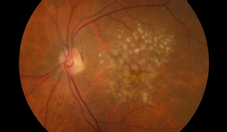 Ocular Imaging - Fundus photo showing numerous soft drusen scattered throughout the macula.