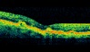Ocular Imaging - OCT of drusen at the level of the retinal pigment epithelial cells.