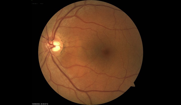 Ocular Imaging - Fundus photo showing subtle CSR adjacent/ temporal to the optic disc.