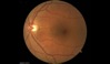Ocular Imaging - Fundus photo showing subtle CSR adjacent/ temporal to the optic disc.