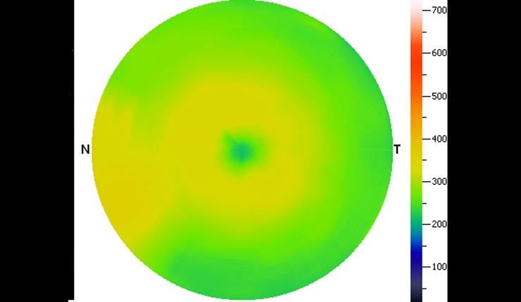 Ocular Imaging - Corresponding topographic thickness map of fundus region highlighting shallow fluid temporal to the disc at the left hand side of the image (central blue/green area represents the fovea).