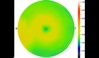 Ocular Imaging - Corresponding topographic thickness map of fundus region highlighting shallow fluid temporal to the disc at the left hand side of the image (central blue/green area represents the fovea).