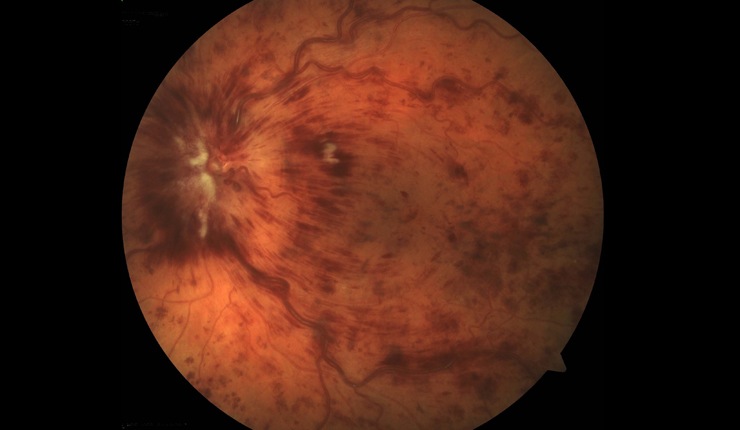 Ocular Imaging - Central retinal vein thrombosis.