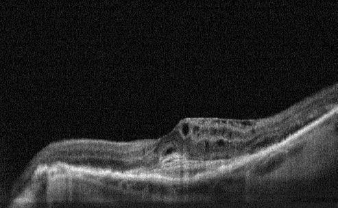 Cystoid Macular Oedema