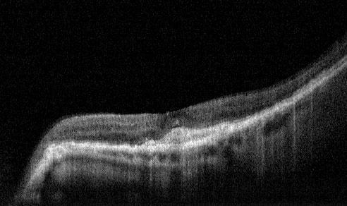 Lucentis Injection