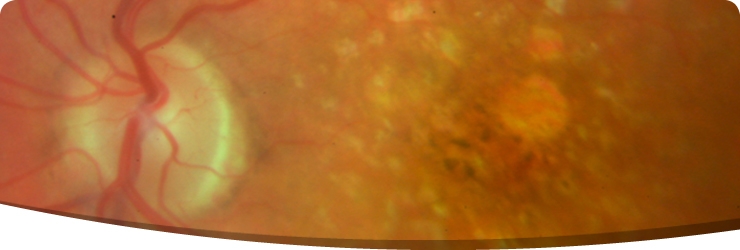 Age-related Macular Degeneration