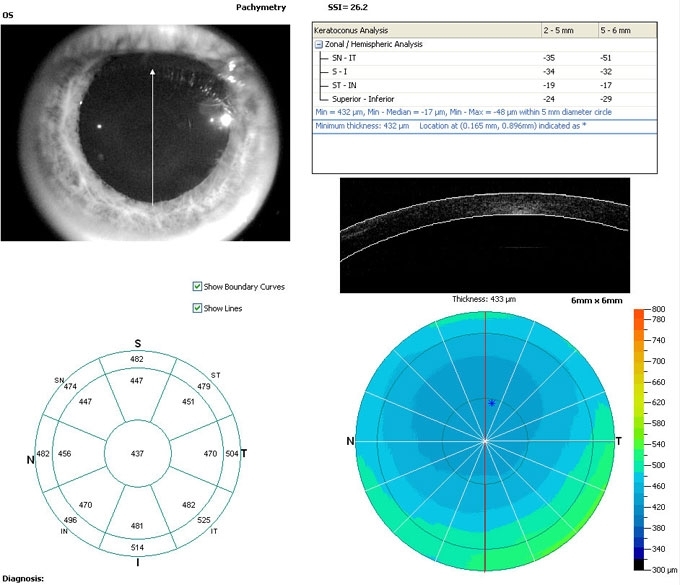 cornea1