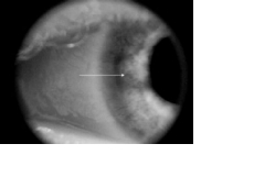 cornea5