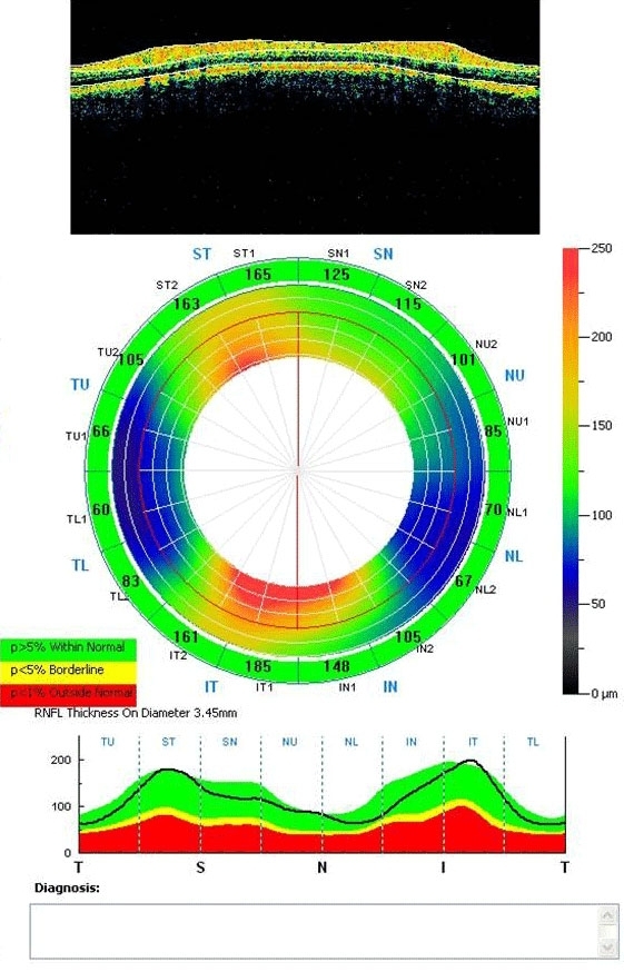 glaucoma2c